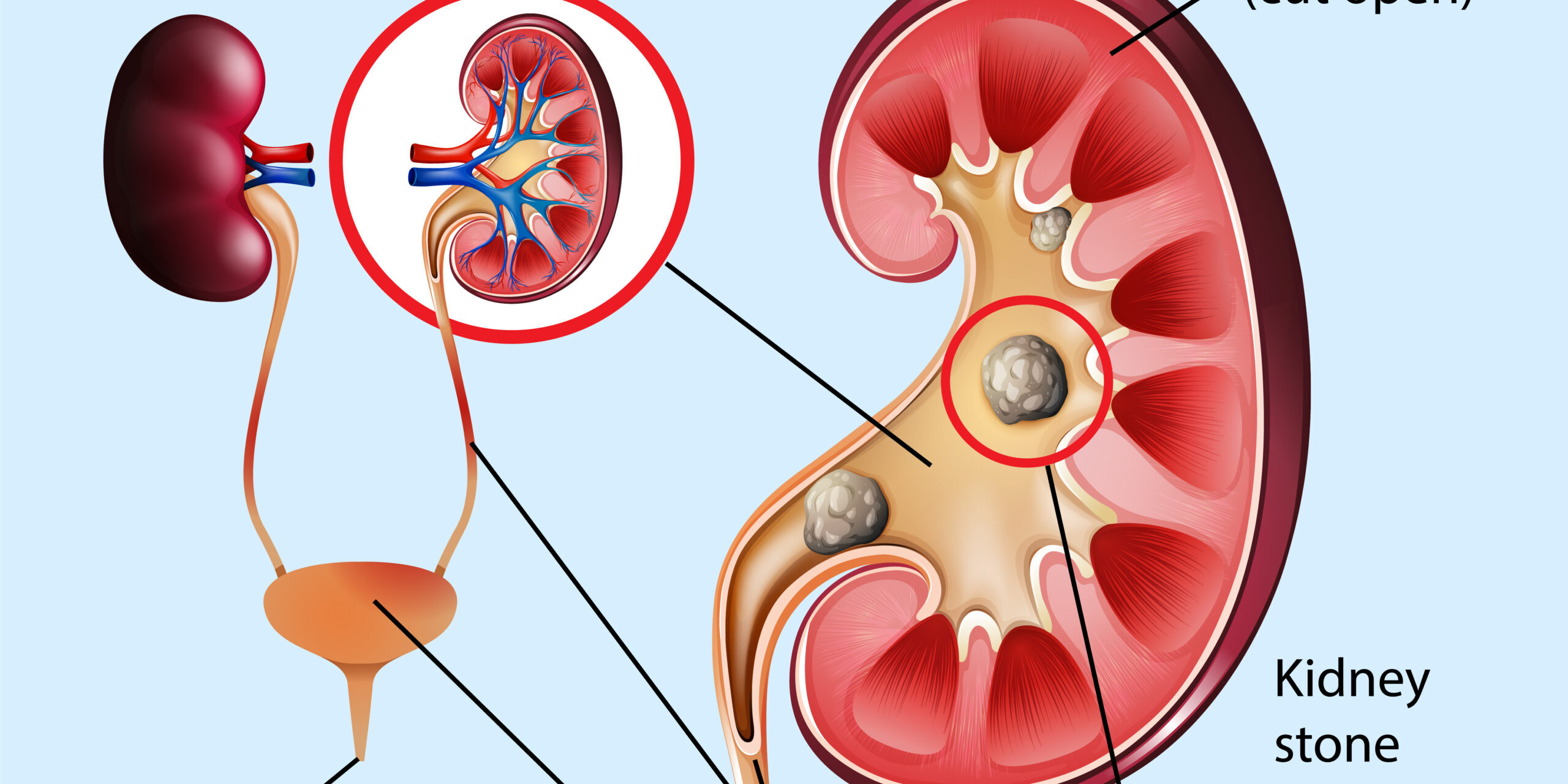 signs-of-kidney-stones